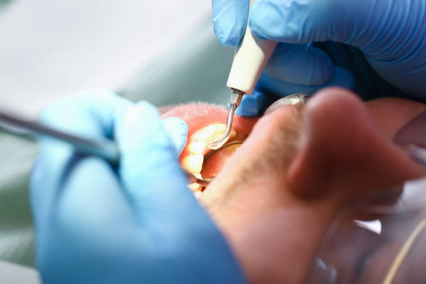 Best Emergency Treatment for Oral Infections in Kiawah Island, SC